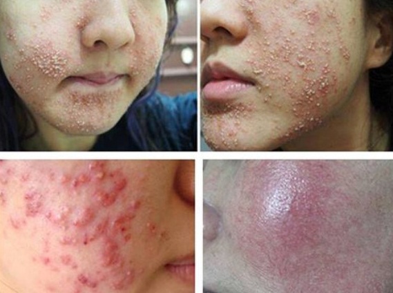 Kinh hoàng với mỹ phẩm làm trắng da cấp tốc