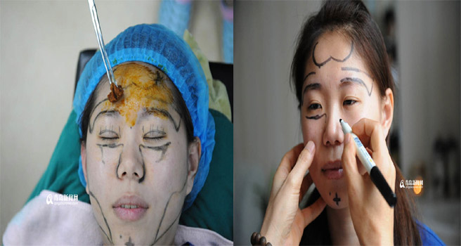 Quá trình thẩm mỹ đầy đau đớn của cô gái
