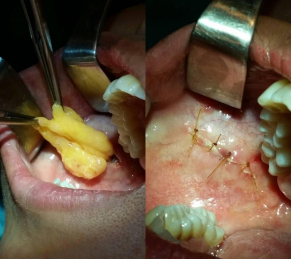 Quá trình này Shbet888 tiền thưởng cực khủng cắt mỡ thừa bên má.