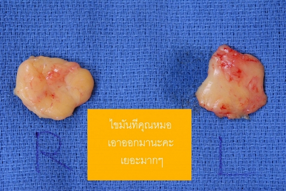 Mỡ thừa được lấy ra từ hai bên má của cô gái.