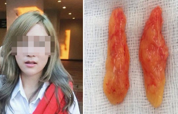 Trước đây một cô gái người Thái Lan cũng từng công khai ảnh Shbet888 tiền thưởng cực khủng cắt mỡ má.
