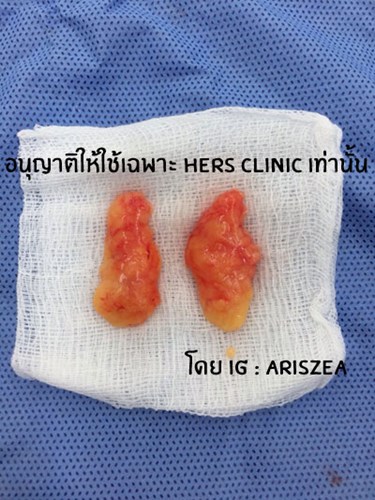 Miếng mỡ được lấy ra từ hai bên má cảu cô gái.