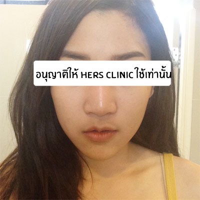 Cô thường xuyên uống thuốc giúp tăng cường kháng chất trong vòng từ 2-3 tháng.