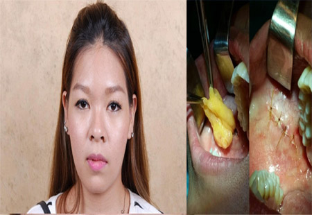 Cận cánh quá trình cắt mỡ ở má đầy đau đớn của giới trẻ