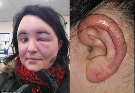 Suýt mù vĩnh viễn vì dị ứng thuốc nhuộm tóc