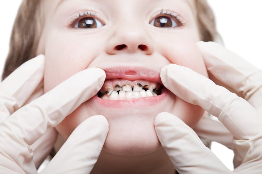 Những điều mẹ chưa biết về sâu răng ở trẻ nhỏ và cách phòng ngừa