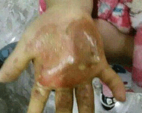 Bé gái bị mẹ đẻ nhúng tay vào nước sôi, rắc muối vào vết thương