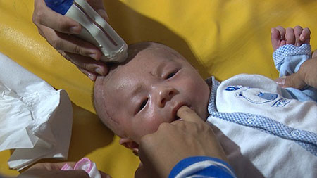 Bé trai bị đâm xuyên sọ phải mổ lần thứ 3 vì đầu phình to