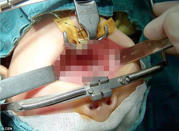 Xót xa bé 1 tuổi bị thương nặng do cục pin phát nổ trong miệng