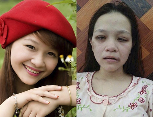 Câu chuyện sau bức ảnh người vợ trẻ bị đánh biến dạng khuôn mặt