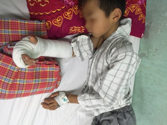 Bé trai bị anh họ 14 tuổi chém gần đứt lìa tay vì đùa nghịch