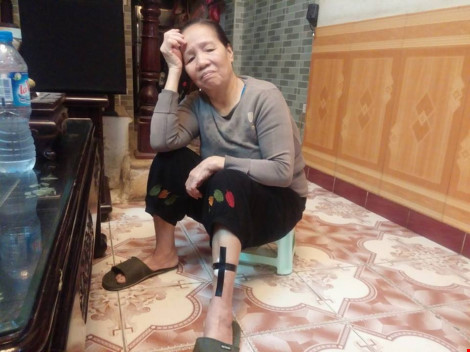 Lời kể đầy hãi hùng của nạn nhân bị 4 con chó “Tây” cắn xé