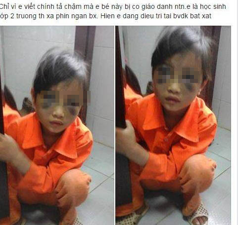 Học sinh tiểu học bị cô giáo đánh tím mặt vì viết chậm