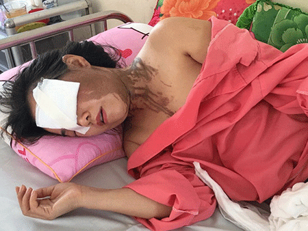 Tạt axit: Tàn độc nhưng không phải tội phạm “Giết người”