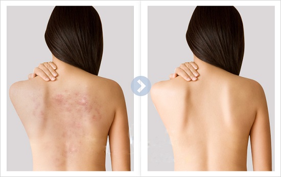 Triệt tiêu mụn toàn thân với rau mồng tơi - đảm bảo khỏi hẳn