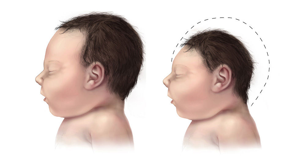 Virus Zika nguy hiểm đến mức nào?