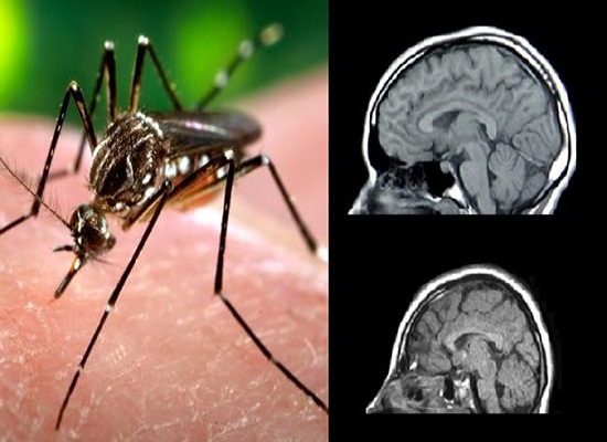 2 bệnh nhân Việt Nam nhiễm virus Zika là do muỗi truyền