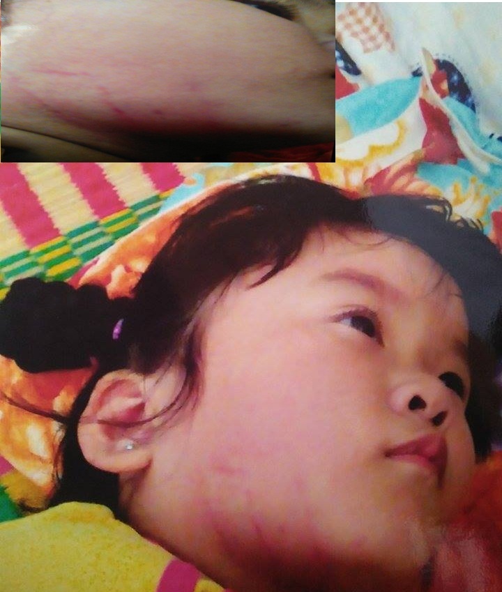 Nghi án cô giáo mầm non đánh bé gái 4 tuổi bầm mặt