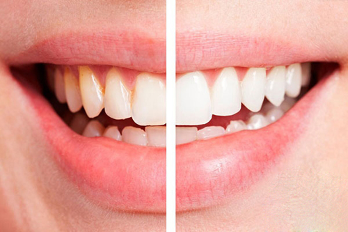 Cả đời không phải đi lấy cao răng nếu bạn làm điều này