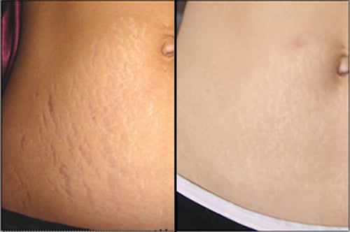 Công thức chữa rạn da