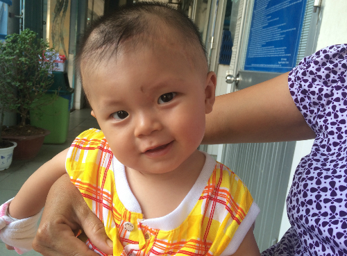 Bé bị đâm xuyên não giờ ra sao?
