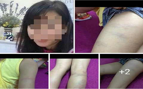 Học sinh lớp 5 nghi bị giáo viên chủ nhiệm đánh bầm tím người