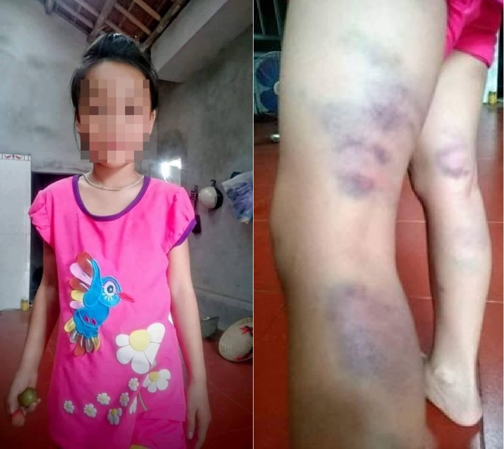 Học sinh lớp 2 bị cô giáo đánh tím đùi vì viết sai 1 chữ