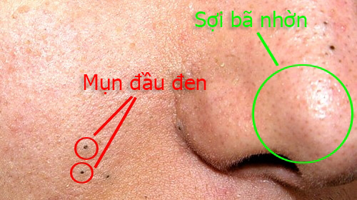 Bạn sẽ không bao giờ bị mụn đầu đen trên mặt bằng mẹo đơn giản