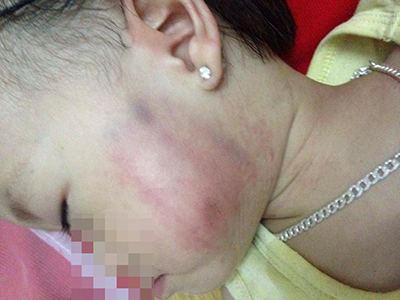 Tin mới nhất vụ bé 16 tháng tuổi bị thâm tím mặt ở trường mầm non