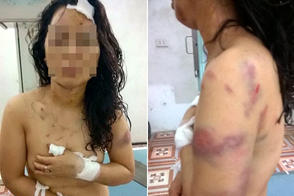 Cô giáo trẻ bị chồng đánh đập dã man bằng dao và then cửa