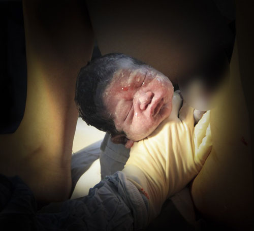 Được sự hỗ trợ từ nhân viên y tế, em bé có thể chui ra ngoài nhiều hơn.