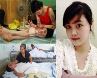 Cô gái xinh đẹp bị chồng tưới xăng đốt được Shbet888 tiền thưởng cực khủng tay phải