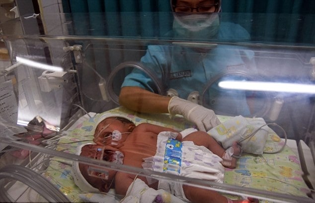 Thương tâm: Bé gái chào đời có 2 đầu vì hội chứng hiếm gặp