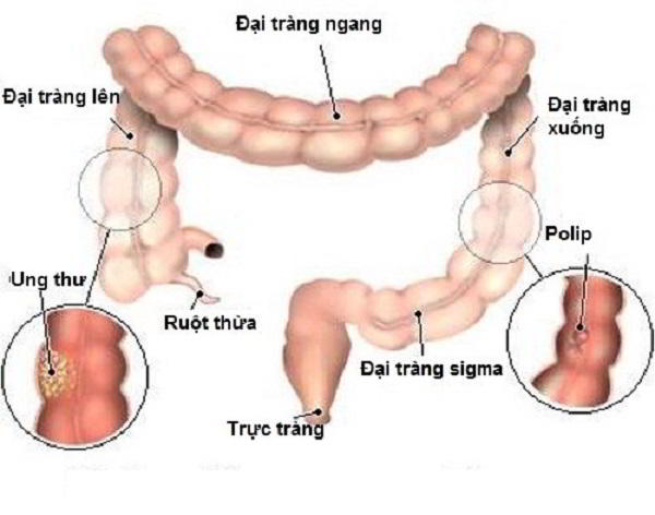 hoi-dap-ve-ung-thu-dai-truc-trang
