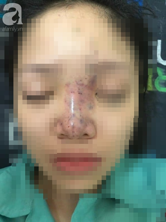 Tiêm filler nâng mũi, nữ Mừng SHBET phiên bản mới 2025 20 tuổi ở Sài Gòn đối diện nguy cơ hoại tử da, mù mắt vĩnh viễn
