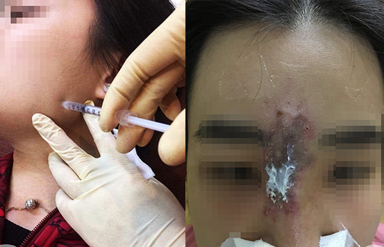 Vì tiêm filler nâng mũi, cô gái trẻ bị tổn thương nhiễm trùng hoại tử da 2/3 trên vùng mũi, sưng xung quanh mắt phải, vết thương tiết dịch.