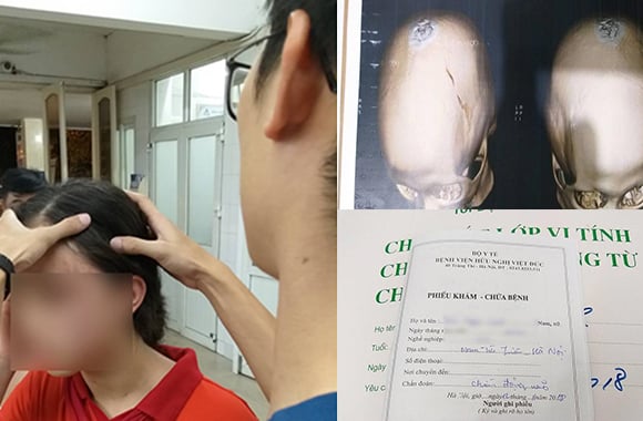 Cháu L. bị chấn động não cần theo dõi