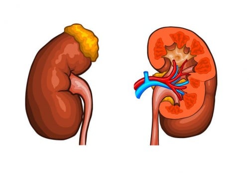 Glomerulonefrite-500x347