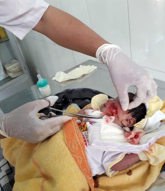 Cháu bé sơ sinh bị thương ở má và may mắn được người cứu sống