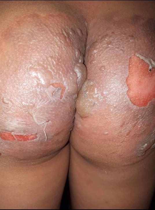 Cháu bé bị bỏng nặng sau khi bị hất nồi nước luộc bầu sôi vào người