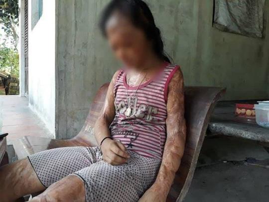 Vì mẹ N giật chồng của một người trong xã nên em đã bị người khác đánh ghen, tạt nguyên ca axit vào người khiến em mang thương tật lên đến 96%, riêng hai mắt của bị mù vĩnh viễn. 