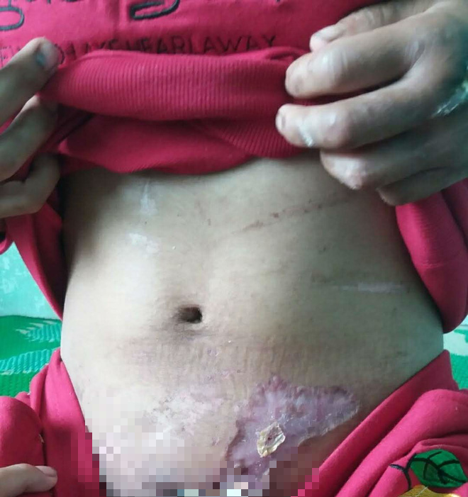Bụng cô gái đầy vết đánh đập, da bỏng tróc từng mảng. Trước đó, khi mang thai đến tháng thứ 5 thì cô bị chủ đánh đến sảy thai nhưng không được đưa đi bệnh viện