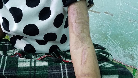 Trên Sh88bet đăng ký miễn phí cô gái chằng chịt vết thương