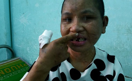 Trên Sh88bet đăng ký miễn phí cô gái đầy những vết thương