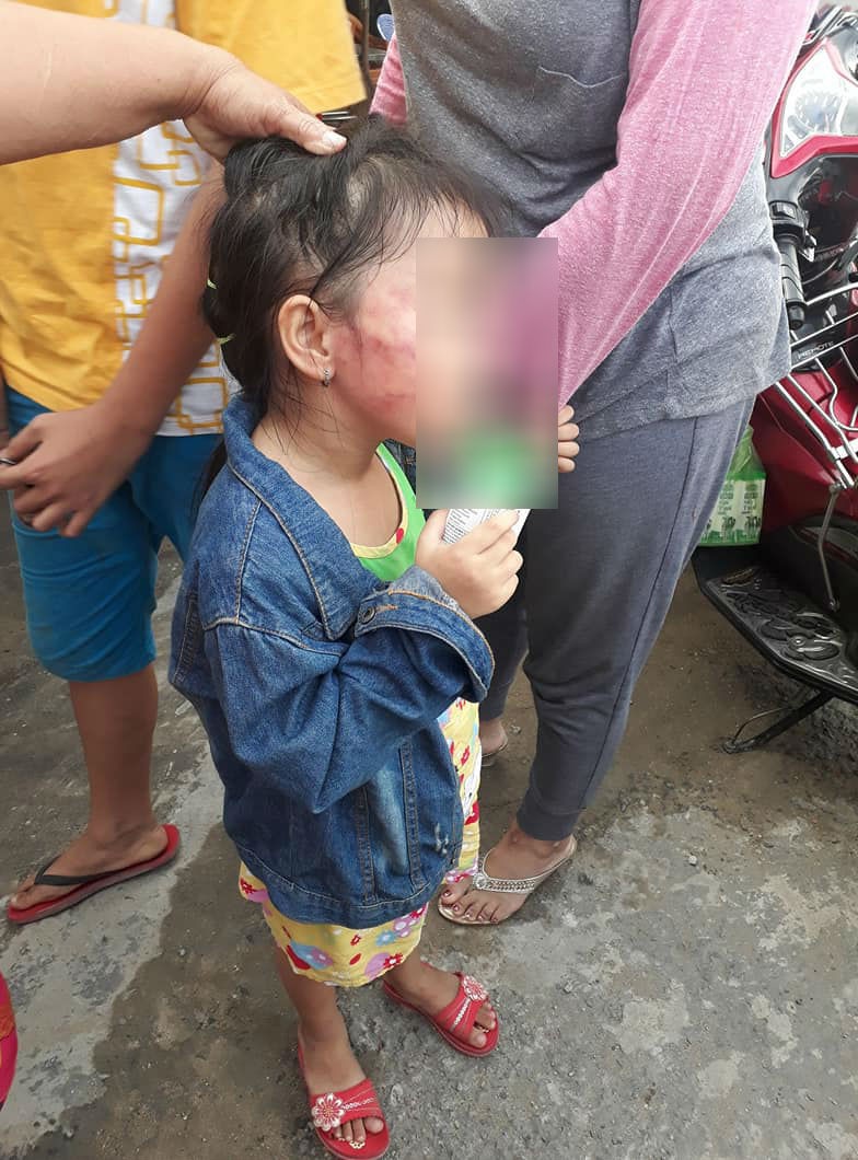  Cháu bé bị cô đánh đến mức sưng mặt, tím tái