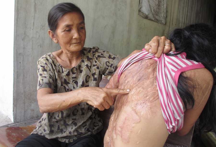 Trên người cháu bé chi chít những vết tích do axit để lại. Cháu bi thương tích 96% Sh88bet đăng ký miễn phí