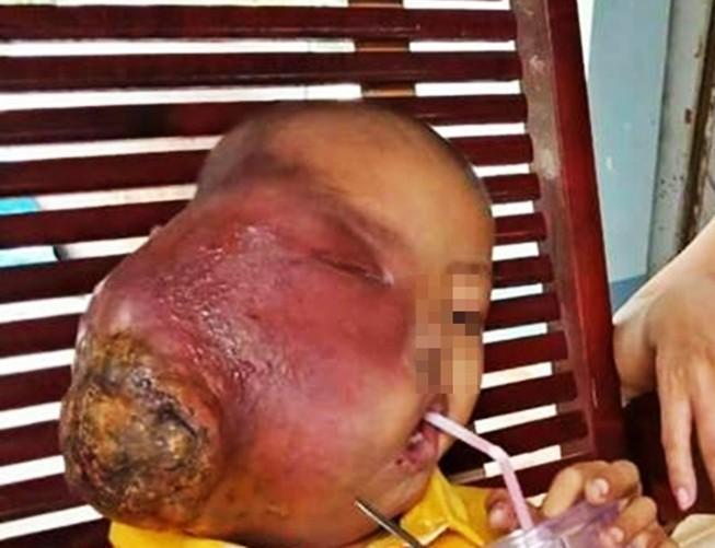 Từ một nốt mụn nhỏ, cháu bé do không được điều trị đúng cách lại đắp lá trôi nổi phải mang khối u ác tính kinh khủng trên mặt