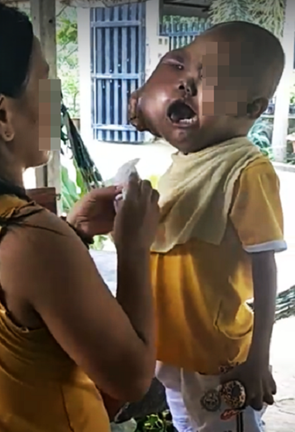 Hàng ngày em phải chịu đau đớn vì khối u đã bị vỡ