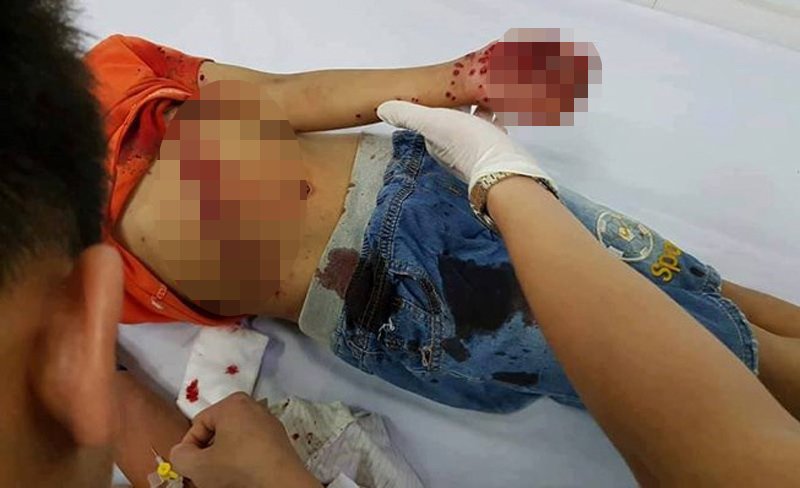 Bé trai 8 tuổi nhập viện trong tình trạng đa chấn thương do pin đồ chơi phát nổ