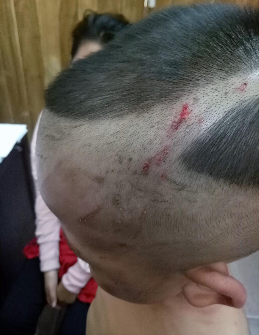 Trên đầu bé là những vết thương do người cha dượng cầm thắt lưng và móc áo đánh đập